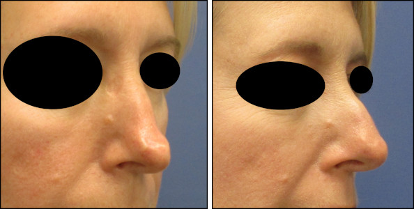 rhinoplasty
